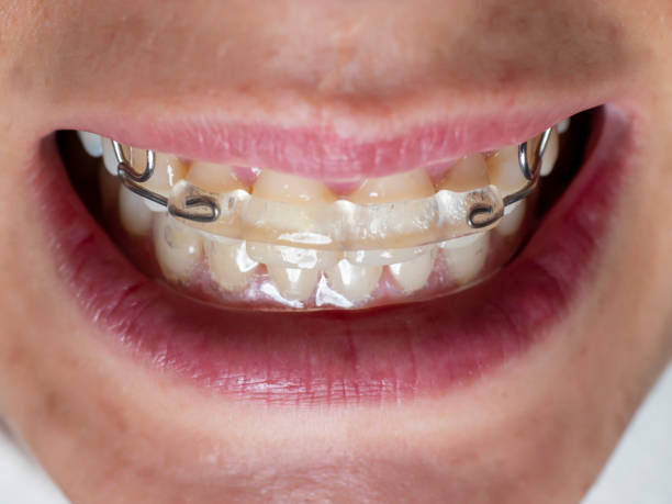 hawthorn clear braces